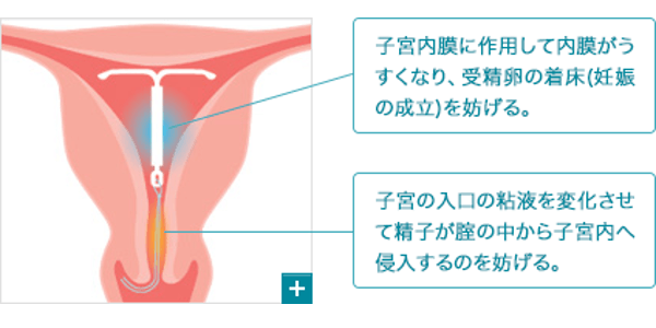IUS（ミレーナ）装着の図解